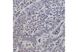 Immunohistochemistry of paraffin-embedded human colon carcinoma using MonoMethyl-Histone H3-K9 antibody (ABIN7267685) at dilution of 1:100 (40x lens).