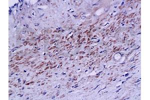 Formalin-fixed and paraffin embedded human prostate labeled with Rabbit Anti phospho-Androgen Receptor(Ser578) Polyclonal Antibody, Unconjugated (ABIN730123) at 1:200 followed by conjugation to the secondary antibody and DAB staining (Androgen Receptor Antikörper  (pSer578))