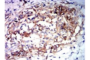 Immunohistochemical analysis of paraffin-embedded stomach cancer tissues using MUC2 mouse mAb with DAB staining. (MUC2 Antikörper  (AA 4373-4557))