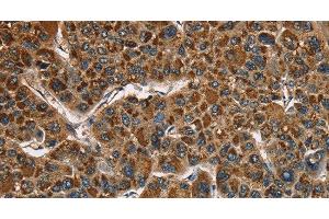 Immunohistochemistry of paraffin-embedded Human liver cancer using CAT Polyclonal Antibody at dilution of 1:40 (Catalase Antikörper)