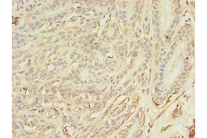 Immunohistochemistry of paraffin-embedded human breast cancer using ABIN7144179 at dilution of 1:100 (ASB11 Antikörper  (AA 41-315))