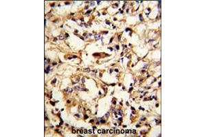 Formalin-fixed and paraffin-embedded human breast carcinoma reacted with DFNA5 Antibody (N-term), which was peroxidase-conjugated to the secondary antibody, followed by DAB staining. (DFNA5 Antikörper  (N-Term))