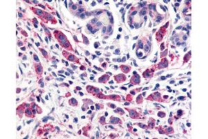 Anti-ELTD1 antibody IHC of human Breast, Carcinoma.
