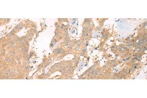 Immunohistochemistry of paraffin-embedded Human colorectal cancer tissue using ASIC3 Polyclonal Antibody at dilution of 1:40(x200) (ASIC3 Antikörper)