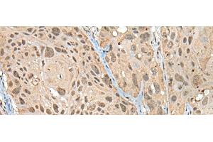 Immunohistochemistry of paraffin-embedded Human esophagus cancer tissue using ZNF468 Polyclonal Antibody at dilution of 1:30(x200) (ZNF468 Antikörper)
