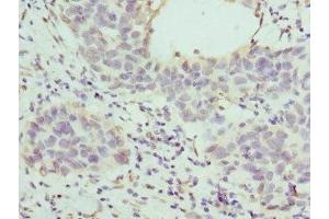 Immunohistochemistry of paraffin-embedded human bladder cancer using ABIN7155947 at dilution of 1:100 (HAPLN1 Antikörper  (AA 165-354))