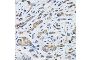 Immunohistochemistry of paraffin-embedded human gastric cancer using SLC16A4 antibody. (SLC16A4 Antikörper)
