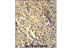 immunohistochemistry analysis in formalin fixed and paraffin embedded human cervix carcinoma followed by peroxidase conjugation of the secondary antibody and DAB staining. (FOXC2 Antikörper  (AA 159-186))