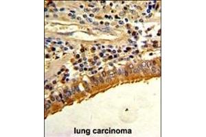 Formalin-fixed and paraffin-embedded human lung carcinoma with S Antibody (C-term), which was peroxidase-conjugated to the secondary antibody, followed by DAB staining. (Osteopontin Antikörper  (C-Term))