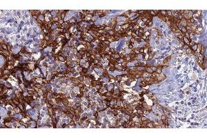 ABIN6279138 at 1/100 staining Human Head and neck cancer tissue by IHC-P. (Aquaporin 8 Antikörper  (N-Term))