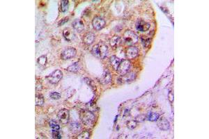 Immunohistochemical analysis of PDHA1 staining in human lung cancer formalin fixed paraffin embedded tissue section.