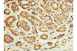 Immunohistochemistry of paraffin-embedded human breast cancer using ABIN7143229 at dilution of 1:100 (ACSM3 Antikörper  (AA 387-586))