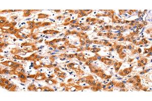 Immunohistochemistry of paraffin-embedded Human liver cancer tissue using FBLN1 Polyclonal Antibody at dilution 1:47