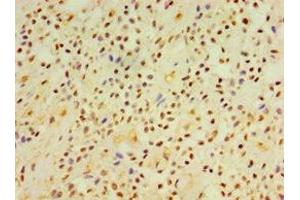 Immunohistochemistry of paraffin-embedded human breast cancer using ABIN7149845 at dilution of 1:100