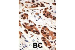 Formalin-fixed and paraffin-embedded human cancer tissue reacted with GJB5 polyclonal antibody  , which was peroxidase-conjugated to the secondary antibody, followed by AEC staining. (GJB5 Antikörper  (Internal Region))