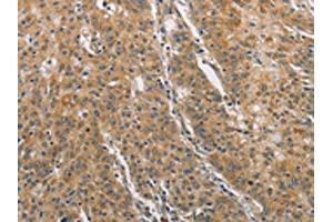 The image on the left is immunohistochemistry of paraffin-embedded Human gastric cancer tissue using ABIN7129185(DDX53 Antibody) at dilution 1/75, on the right is treated with fusion protein. (DDX53 Antikörper)