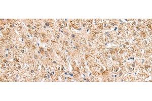 Immunohistochemistry of paraffin-embedded Human liver cancer tissue using HCCS Polyclonal Antibody at dilution of 1:110(x200) (HCCS Antikörper)