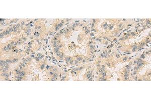 Immunohistochemistry of paraffin-embedded Human lung cancer tissue using HHIPL2 Polyclonal Antibody at dilution of 1:55(x200) (HHIPL2 Antikörper)