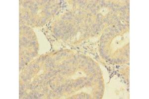 Immunohistochemistry of paraffin-embedded human endometrial cancer using ABIN7149718 at dilution of 1:100 (DNTTIP1 Antikörper  (AA 1-329))