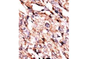 Formalin-fixed and paraffin-embedded human cancer tissue reacted with the primary antibody, which was peroxidase-conjugated to the secondary antibody, followed by AEC staining. (BCKDK Antikörper  (AA 120-151))
