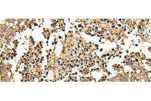 Immunohistochemistry of paraffin-embedded Human lung cancer tissue using LDHA Polyclonal Antibody at dilution of 1:25(x200) (Lactate Dehydrogenase A Antikörper)