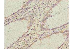 Immunohistochemistry of paraffin-embedded human colon cancer using ABIN7147439 at dilution of 1:100 (CEP95 Antikörper  (AA 582-821))