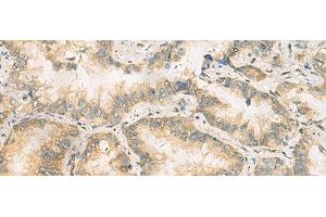 Immunohistochemistry of paraffin-embedded Human lung cancer tissue using RAB13 Polyclonal Antibody at dilution of 1:50(x200) (RAB13 Antikörper)