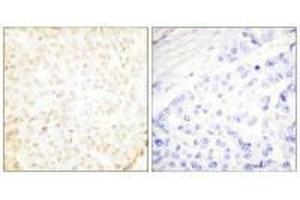 Immunohistochemistry analysis of paraffin-embedded human breast carcinoma tissue using XRCC5 antibody. (XRCC5 Antikörper  (C-Term))