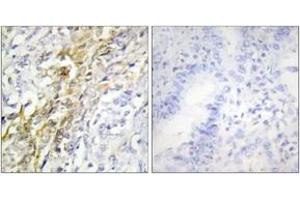 Immunohistochemistry analysis of paraffin-embedded human lung carcinoma tissue, using CKI-alpha Antibody. (CSNK1A1 Antikörper  (AA 126-175))
