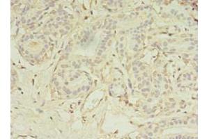 Immunohistochemistry of paraffin-embedded human breast cancer using ABIN7159399 at dilution of 1:100 (MS4A7 Antikörper  (AA 1-47))