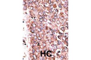 Formalin-fixed and paraffin-embedded human hepatocellular carcinoma tissue reacted with WISP3 polyclonal antibody  , which was peroxidase-conjugated to the secondary antibody, followed by DAB staining. (WISP3 Antikörper  (Internal Region))