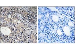 Immunohistochemistry analysis of paraffin-embedded human prostate carcinoma tissue, using RPL17 Antibody.