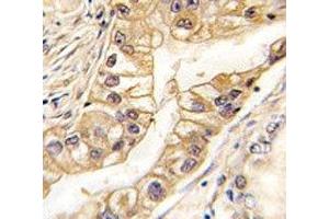 IHC analysis of FFPE human lung carcinoma tissue stained with EPHB2 antibody (EPH Receptor B2 Antikörper)