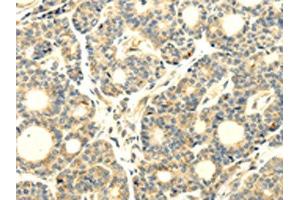 The image on the left is immunohistochemistry of paraffin-embedded Human thyroid cancer tissue using ABIN7193043(WDR91 Antibody) at dilution 1/20, on the right is treated with synthetic peptide. (WDR91 Antikörper)