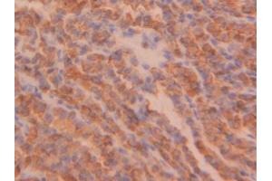IHC-P analysis of Human Thyroid cancer Tissue, with DAB staining. (PPIB Antikörper  (AA 47-216))