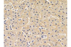 GGA3 Antibody at 1/100 staining human liver cancer by IHC-P.