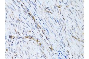Immunohistochemistry of paraffin-embedded human uterine cancer using SELE Antibody (ABIN5971217) at dilution of 1/100 (40x lens). (Selectin E/CD62e Antikörper)
