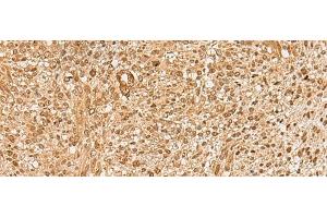 Immunohistochemistry of paraffin-embedded Human liver cancer tissue using HIRIP3 Polyclonal Antibody at dilution of 1:60(x200) (HIRIP3 Antikörper)