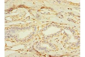 Immunohistochemistry of paraffin-embedded human breast cancer using ABIN7159074 at dilution of 1:100 (MXD3 Antikörper  (AA 1-206))