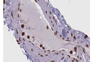 ABIN6267660 at 1/100 staining human lung carcinoma tissue sections by IHC-P.