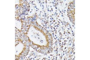 Immunohistochemistry of paraffin-embedded human colon carcinoma using RHOG antibody (ABIN7269864) at dilution of 1:100 (40x lens). (RHOG Antikörper)