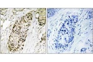 Immunohistochemistry analysis of paraffin-embedded human lung carcinoma tissue, using GA45G Antibody. (GADD45G Antikörper  (AA 101-150))