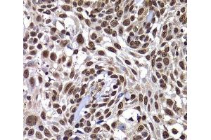 Immunohistochemistry of paraffin-embedded Human well-differentiated squamous skin carcinoma using DNAJB6 Polyclonal Antibody at dilution of 1:100 (40x lens). (DNAJB6 Antikörper)