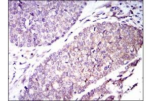 Immunohistochemical analysis of paraffin-embedded esophageal cancer tissues using GUCY1A3 mouse mAb with DAB staining. (GUCY1A1 Antikörper  (AA 22-214))