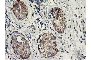 Immunohistochemical staining of paraffin-embedded Adenocarcinoma of Human breast tissue using anti-DAND5 mouse monoclonal antibody. (DAND5 Antikörper  (AA 23-189))