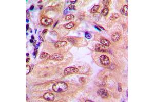 Immunohistochemical analysis of SMAD1/9 (pS465/467) staining in human breast cancer formalin fixed paraffin embedded tissue section.