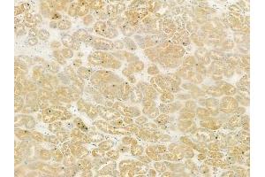 ABIN6261091 and ABIN6279109 at 1/100 staining human renal cell carcinoma by IHC-P.