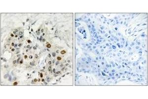 Immunohistochemistry analysis of paraffin-embedded human breast carcinoma tissue, using AF4 Antibody.