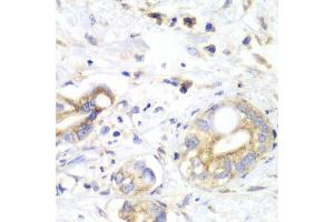 Immunohistochemistry of paraffin-embedded human liver cancer using TXN2 antibody (ABIN6291019) at dilution of 1:100 (40x lens). (TXN2 Antikörper)