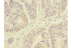 Immunohistochemistry of paraffin-embedded human colon cancer using ABIN7167980 at dilution of 1:100 (ARHGEF3 Antikörper  (AA 287-526))